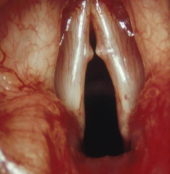 HOW SINGERS CAN STAY CLEAR OF VOCAL NODULES WITH DOCTORVOX